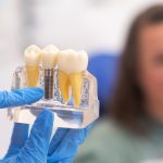 How Dental Implants Influence Vitamin Absorption and Nutritional Wellbeing Through Improved Mastication